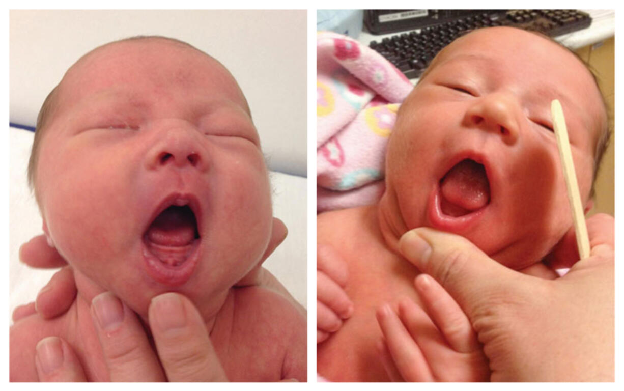 This combination of photos provided by Dr. Maya Bunik in July 2024, shows a baby with ankyloglossia where the tongue does not extend beyond the gums, left, and a baby with an indentation at the tip of a the tongue which may be a sign of ankyloglossia. On Monday, July 29, 2024, one of the largest doctor&rsquo;s groups in the U.S., voiced concerns that the condition, also known as &ldquo;tongue-tie&rdquo; which can affect breastfeeding, is being over-diagnosed and often treated with unnecessary surgery to babies&rsquo; mouths. (Dr.