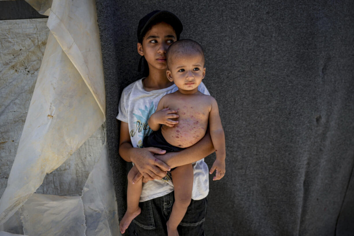 Displaced child Mohammed Abu Obaid, who suffers from skin disease, is seen carried by his sister, at a makeshift tent camp in Deir al-Balah, central Gaza Strip, Monday, July 29, 2024. Skin diseases are running rampant in Gaza, health officials say, from appalling conditions in overcrowded tent camps housing hundreds of thousands of Palestinians driven from their homes.