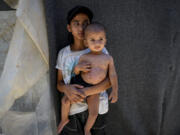 Displaced child Mohammed Abu Obaid, who suffers from skin disease, is seen carried by his sister, at a makeshift tent camp in Deir al-Balah, central Gaza Strip, Monday, July 29, 2024. Skin diseases are running rampant in Gaza, health officials say, from appalling conditions in overcrowded tent camps housing hundreds of thousands of Palestinians driven from their homes.