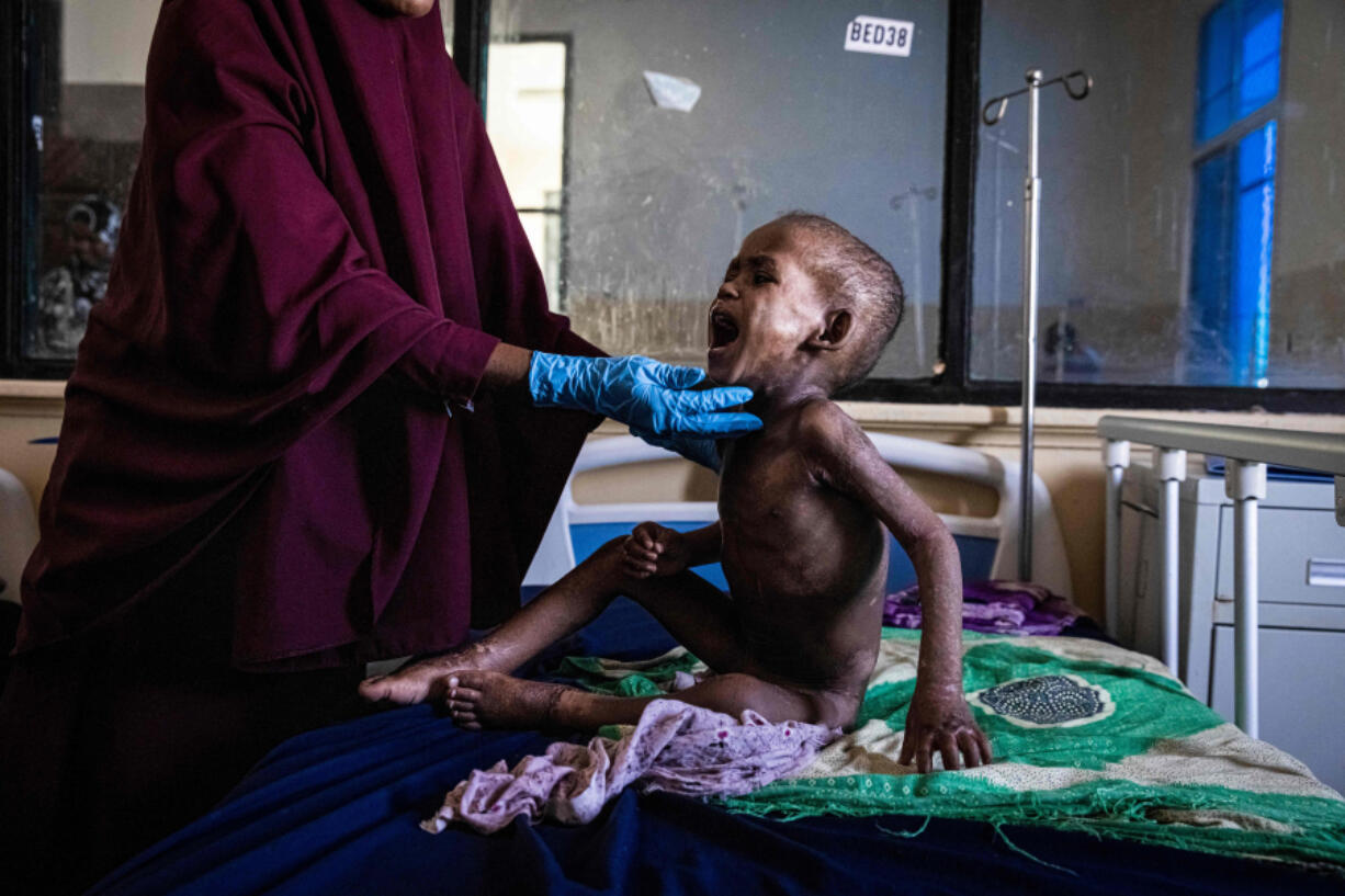 Ali Abdullahi Mohamed, a severely malnourished 27-month-old boy, is examined by a nurse June 1, 2022, in Banadir Maternity and Children Hospital in Mogadishu, Somalia.