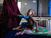 Ali Abdullahi Mohamed, a severely malnourished 27-month-old boy, is examined by a nurse June 1, 2022, in Banadir Maternity and Children Hospital in Mogadishu, Somalia.